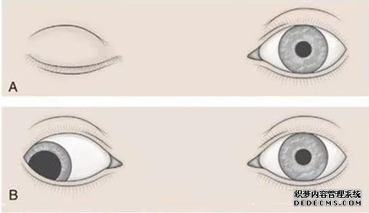  斜視手術后易發生哪些并發癥